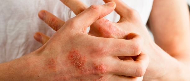 Atopic dermatitis